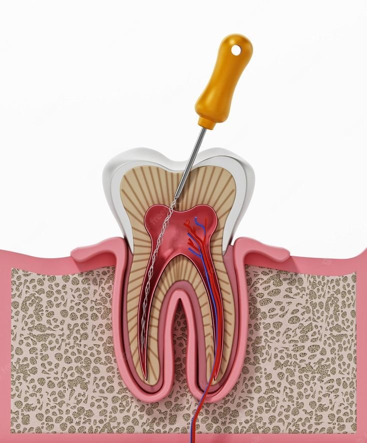 what is root canal therapy